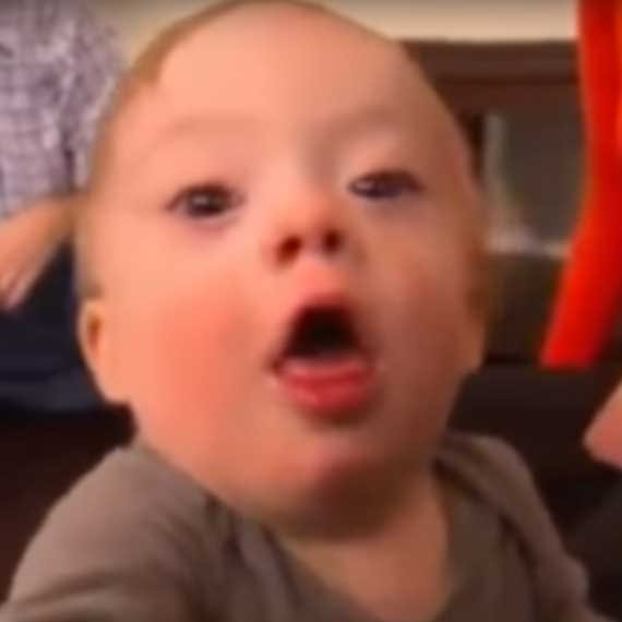 תינוק עם תסמונת דאון