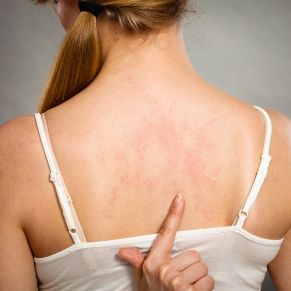 "קמתי בבוקר ועל כל הגוף שלי הייתה פריחה"