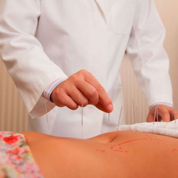 מהו דיקור יבש ומה ההבדל בינו לבין דיקור סיני?